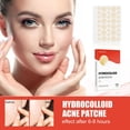 thumbnail image 1 of 144 parches para el acné, para uso diurno y nocturno, 2 en 1, invisibles, efectivos, hidrocoloides que absorben las espinillas del acné, pegatinas impermeables para el acné en la cara, 1 of 5