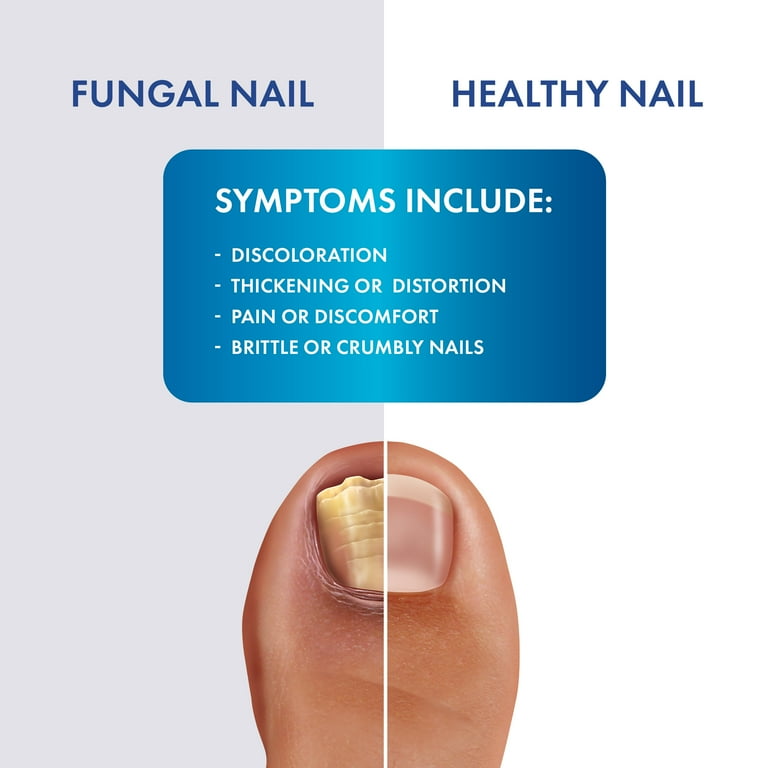 Pro Clearz Fungal Shield Brush-On Antifungal Liquid, Maximum