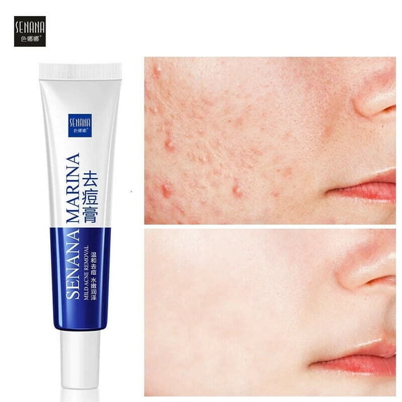 2 Pack Acne Removal Nicotinamide Cream Aloe Vera Oil Control Shrink Pores