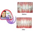 thumbnail image 2 of Professional Kids Dental Guard Brace Mouth Guard Case Children Anti Grinding Relief Bruxism Whitening Tray Replacement White, 2 of 5