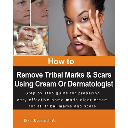 How to Remove Tribal Marks & Scars Using Cream or Dermatologist - (Best Way To Remove Scars)