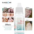 thumbnail image 4 of LANTHOME 10ml Fungal Nail Treatment Dropper Design Mild Portable Bright Nail Toenail Nail Repair, 4 of 5