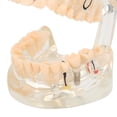 thumbnail image 3 of Modelo Patológico De Dientes Para Adultos, Modelo De Implante Dental, Modelo De Enseñanza De Dientes Para Estudio Dental, 3 of 7