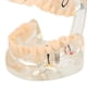 thumbnail image 1 of Modelo patológico de dientes dentales para adultos modelo de implante Dental modelo de enseñanza de dientes para estudio Dental ANGGREK Otros, 1 of 8