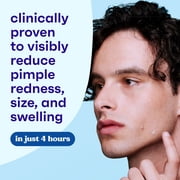 CLEAN & CLEAR ADVANTAGE Acne Spot Treatment, 2% Salicylic Acid, 0.75 fl. oz