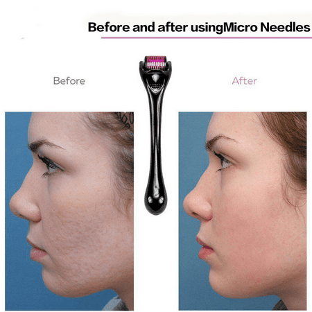 microneedle face roller