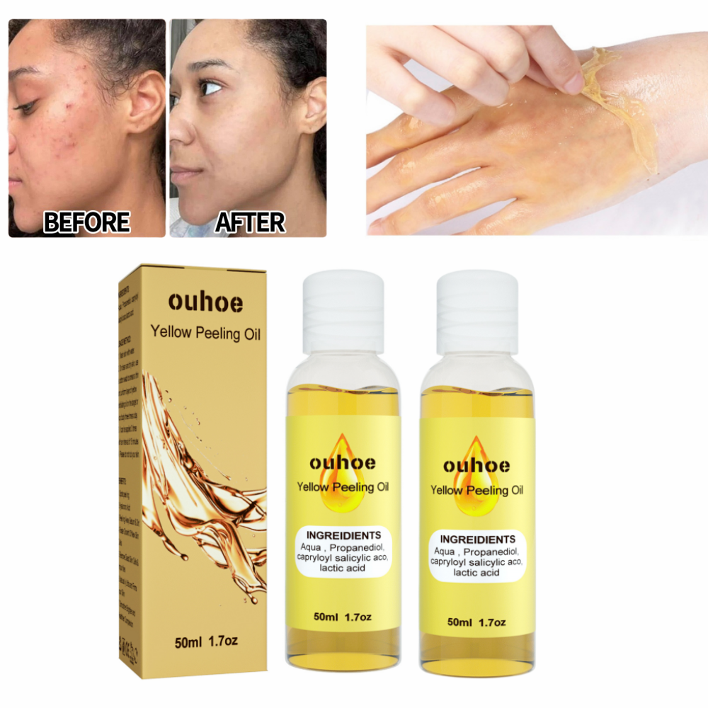 LOYALSE Yellow Peeling Oil,Super Strength Yellow Peeling Solution For