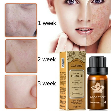 Age Spot Removal - Ultra Brightening Spotless Oil Dark Spots Removal Age Spots Hyper Pigmentation