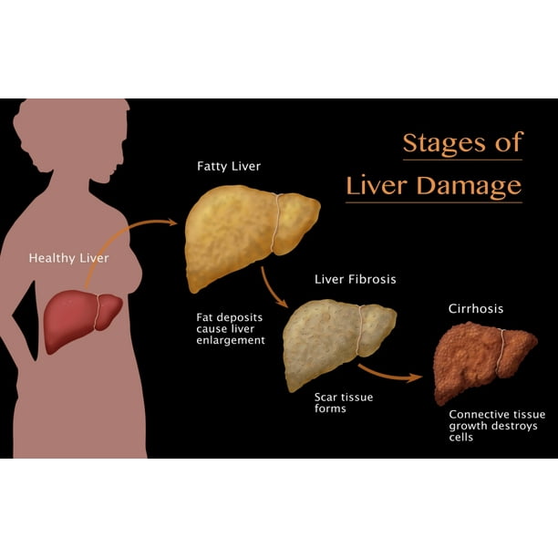 Stages of Liver Damage Poster Print by Monica Schroeder/Science Source