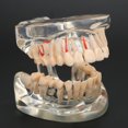 thumbnail image 4 of Modelo Patológico De Dientes Para Adultos, Modelo De Implante Dental, Modelo De Enseñanza De Dientes Para Estudio Dental, 4 of 7