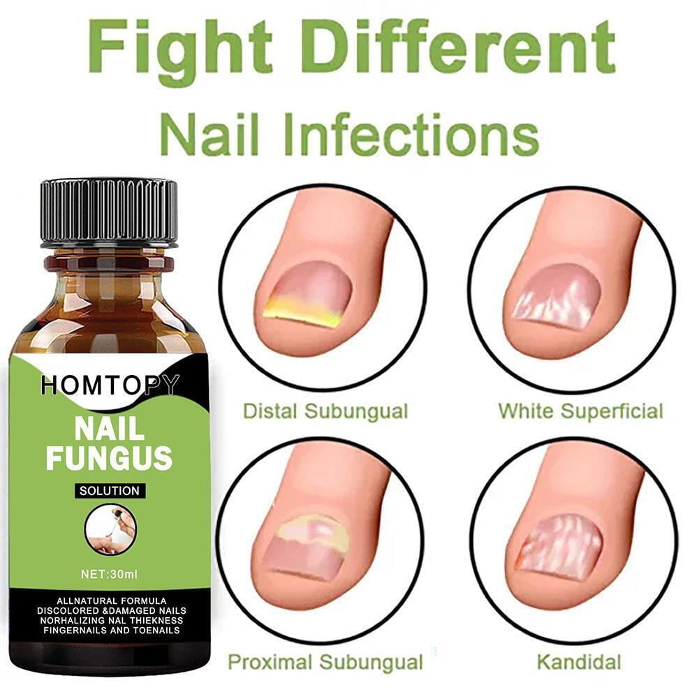 Toenail Fungus Treatment, Eliminate Fungus Fungal Nail Repair Care