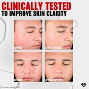 THAYERS Blemish Clearing Salicylic Acid Toner, Acne Treatment Face Toner with 2% Salicylic Acid, Soothing and Non-Stripping Skin Care 12.0 fl. oz.