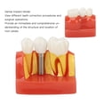thumbnail image 3 of Modelo De Implante Dental, Modelo De Entrenamiento De Dientes De Implante, Demostración De Puente De Extraíble Para Profesionales Para Hospitales, 3 of 7