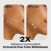 Avarelle Cosmetics ZITOUT X-Large Hydrocolloid Pimple Patch, 8 ct