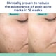thumbnail image 5 of Sérum Cetaphil, suave y transparente, reparador para después del acné, 30 ml, Bakuchiol, 5 of 9