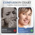thumbnail image 2 of Baweave Outils d'Extraction de Points Noirs en Acier Inoxydable de Qualité Médicale Kit Professionnel pour le Visage, 2 of 16
