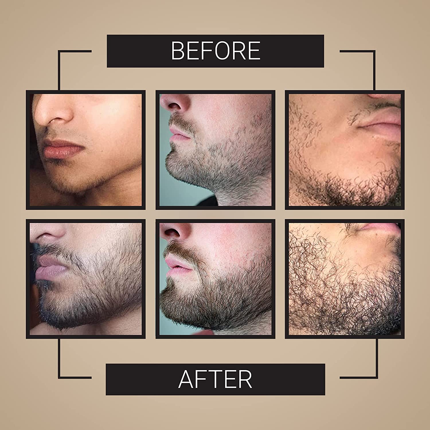 Derma Roller for Beard Growth + Beard Growth Serum - Stimulate Beard and Hair Growth - Derma Roller for Men - Amazing Beard Growth Kit - image 2 of 6