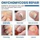 thumbnail image 4 of XIMONTH 32 parches parches para hongos en las uñas para uñas de los pies dañadas nutritivas, 4 of 8