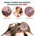 thumbnail image 5 of 3X New Mite Removal Ointment Anti-Itching Plaster Kill Head Lice Skin Care Natural, 5 of 5