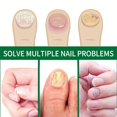 thumbnail image 4 of Nail Care Post, About Subungual Hematoma, Yellow Nail Syndrome, Fungal, 4 of 6