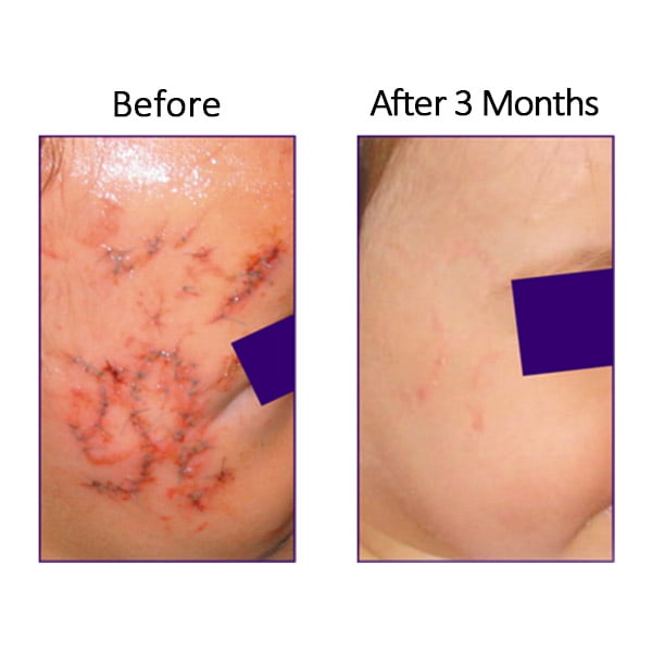 biocorneum scar cream