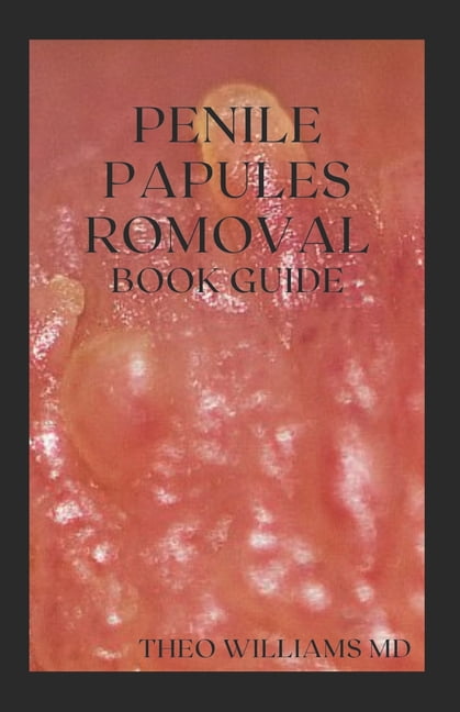 Papules penile to remove naturally pearly how 