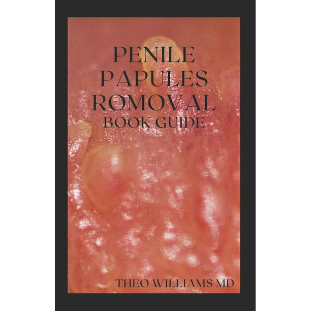Penile papules removal home remedies