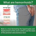 thumbnail image 3 of Hemorrhoids Spray Relieve Swelling Pain Relieve Itching Hemorrhoids Care Eliminate Meatballs Anal Shu Spray - 30Ml-4011483421301, 3 of 4