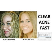 Sulfur Soap for Acne 3-Pack Shipping Included | Joesoef Skin Care Anti Acne Sulfur Soap 100G each 3 pack