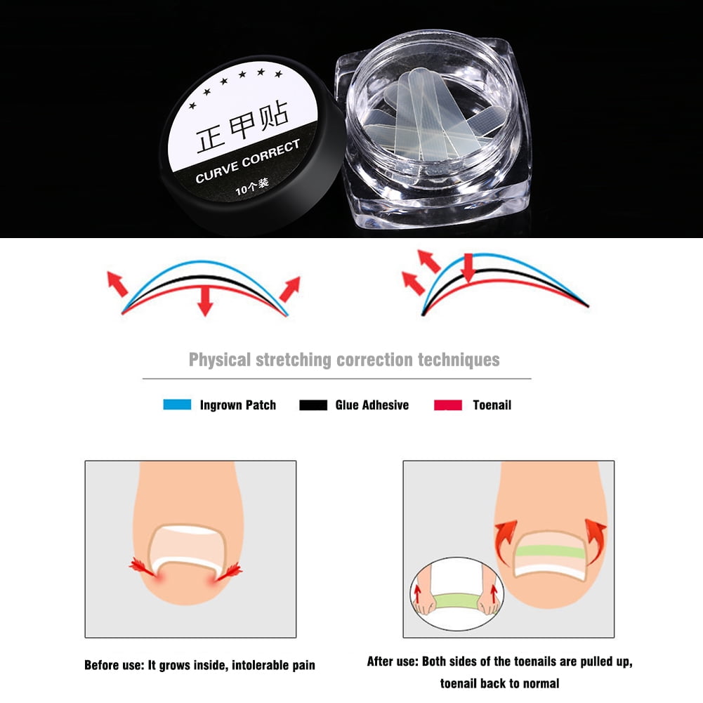 Toenail Correction Tool  Ingrown Patch 10Pcs/Box Toenail Correction Ingrown Sticker Patch Toe Nail Fixer Recover Pedicure Tool