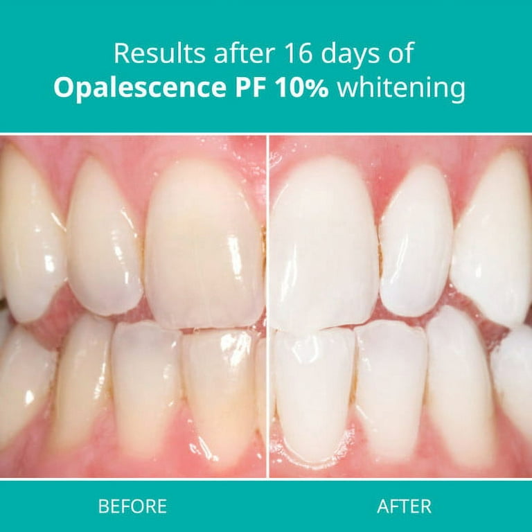 Opalescence PF 10% Mint Teeth Whitening Gel 12 Syringe, Exp. 03/2024