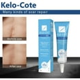 Kelo Cote Local Advanced Formula Scar Gel for Scar Removal 15g