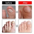 thumbnail image 4 of Barsinfi 30ML Ingrown Toenail Treatment,nail Growth Treatment,ingrown Toenail Drops Cuticle Nail Oil Ingrown Toenail Correction, 4 of 5