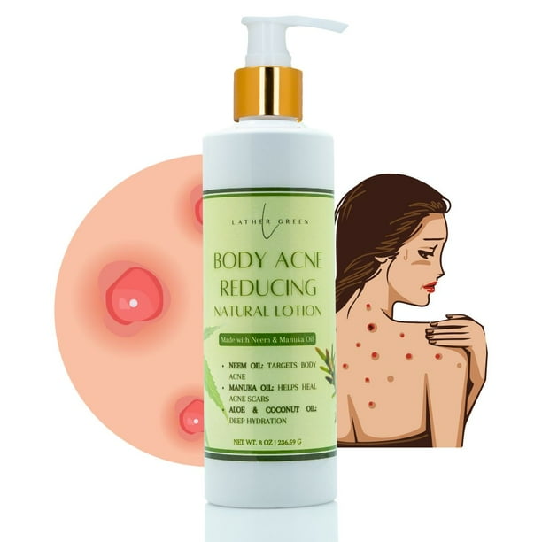 Body Acne Reducing Natural Lotion with Neem & Manuka for Acne Relief & Soothing Hydration, 8 oz by LatherGreen