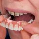 thumbnail image 1 of Extra Thin Fake Bright White Tooth Veneers Silicone Soft Safe Adhesive Denture Hide Shade Braces Comfortable Teeth Orthodontic, 1 of 5