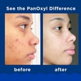 thumbnail image 3 of Jabón facial PanOxyl, jabón espumoso para el acné, peróxido de benzoilo al 10%, 165 ml, 3 of 4