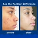 thumbnail image 3 of Jabón facial PanOxyl, jabón espumoso para el acné, peróxido de benzoilo al 10%, 165 ml, 3 of 4