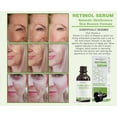 thumbnail image 6 of Dermaxgen Retinol Serum For Face- Pure Retinol (Vitamin A)2.5% + Hyaluronic Acid + Aloe Vera, Anti Wrinkle Face Wrinkles | Renewing and Restore with Hyaluronic Acid, 1 fl oz, 6 of 10