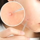 thumbnail image 2 of Cuatro en un removedor de plateado Negrohead Removedor de acero inoxidable Kit de depilación el kit de depilación Acné Whitehead Popping Zit Removing para la cara de la nariz Eigraketly CE001558-00, 2 of 7
