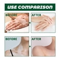 thumbnail image 3 of Crema para el vitíligo de la piel reduce las manchas blancas recuperación de melanina crema para aliviar el vitíligo para todo tipo de piel ANGGREK Otros, 3 of 8