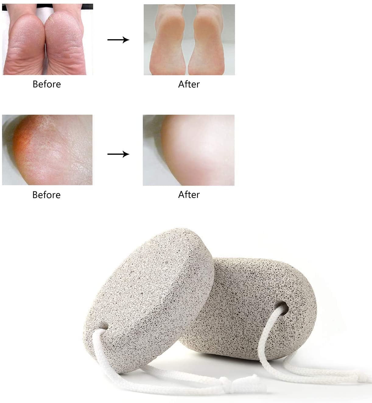 Natural Pumice Stone for Feet, Borogo 2-Pack Lava Pedicure Tools Hard Skin  Callus Remover for Feet and Hands - Natural Foot File Exfoliation to Remove  Dead Skin, Heels, Elbows, Hands 
