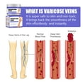 thumbnail image 5 of CYC Varicose Veins Veins Improve Blood Circulation Varicose Vein For Legs And Of Legs Fast (30g), 5 of 5