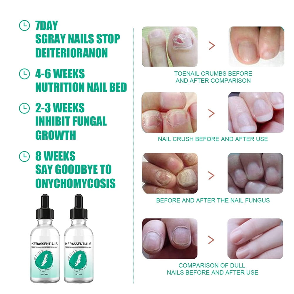 Discover 147+ damaged nail bed repair super hot songngunhatanh.edu.vn