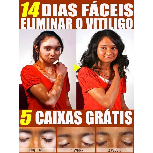 Tratamiento para aliviar el Vitiligo, Spray para el tratamiento de la piel, manchas blancas, pointment0903