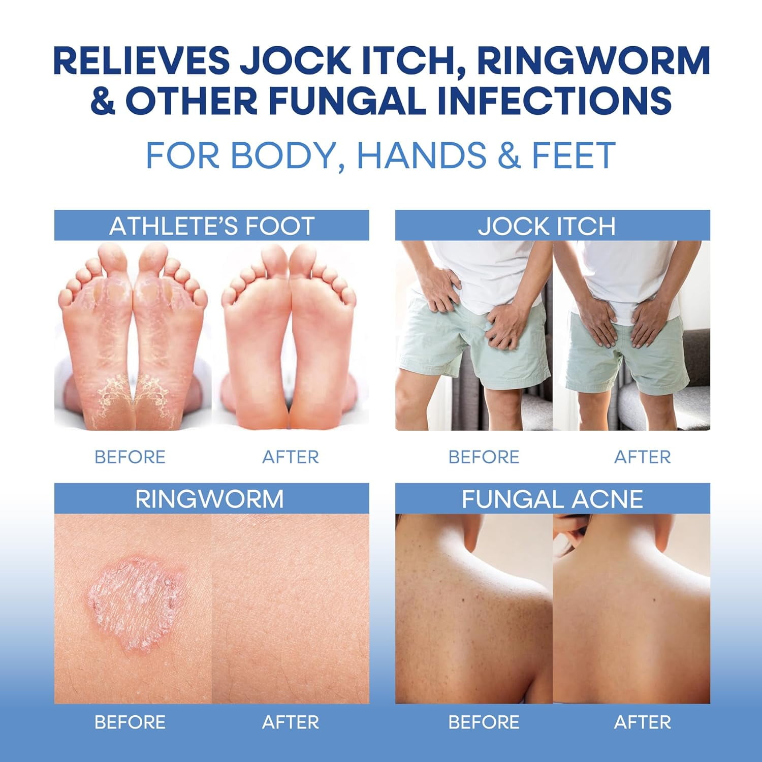Hermon Antifungal Soap with Tea Tree Oil: Antifungal Bar Soothing Care & Relief of Itchy for Ringworm Jock Itch Tinea Versicolor Athletes Foot - Body & Face Wash for Men and Women