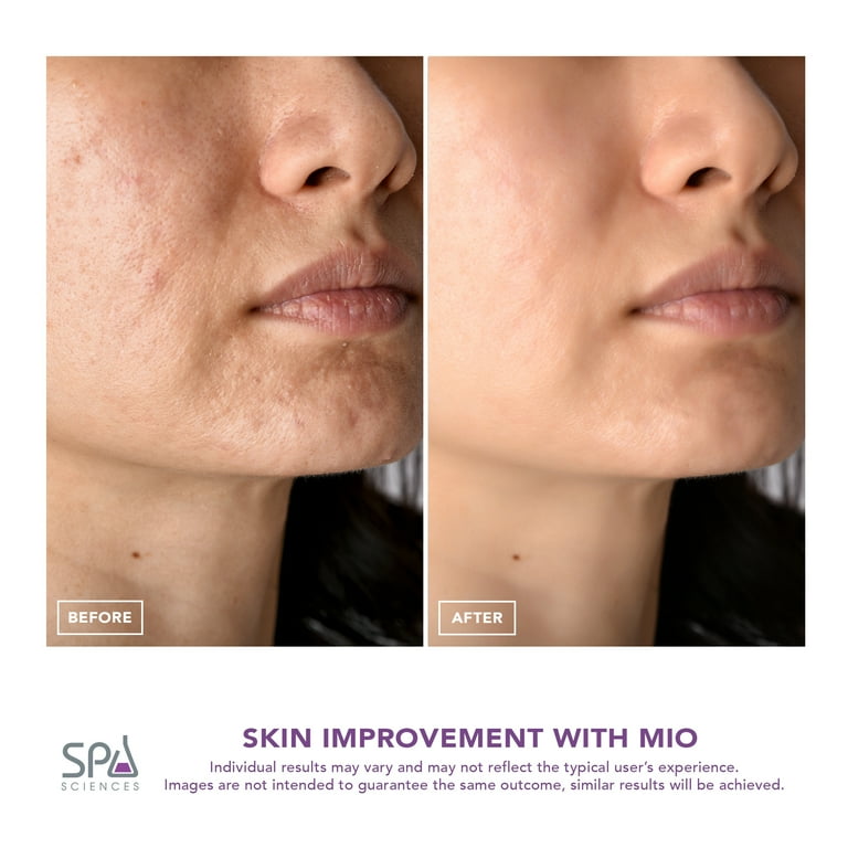 Spa Sciences MIO Diamond Tip Microdermabrasion Device