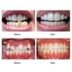thumbnail image 5 of Teeth Straightener, Dental Braces Orthodontic Teeth Trainer Set For Adults, 3 Stage Orthotics Tooth Retainers Alignment, 5 of 5