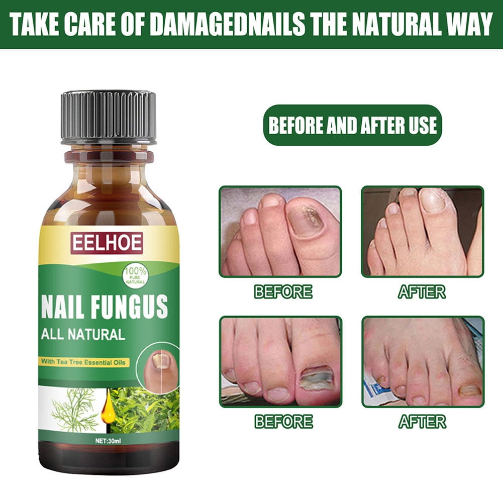 Fungal Nail Repair Solution, Repair Solution with Tea Tree Oil for Discolored and Damaged Nails, 1fl oz Fungal Nail Repair Solution, Repair Solution with Tea Tree Oil for Discolored and Damaged Nails, 1fl oz