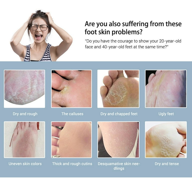 How do you remove dead skin from your feet?