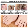 thumbnail image 5 of Ingrowth Toenail Correction Oil Ingrown Toenail Drops Nail Care for Ingrown Toenails, 5 of 5